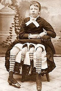 7 Gambar Manusia Dengan Bentuk Tubuh Teraneh Di Dunia 5